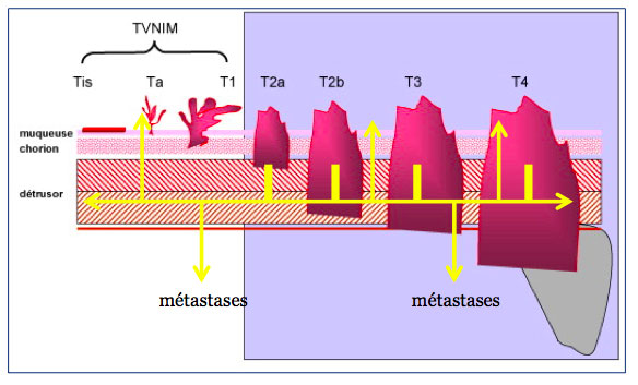 schéma explicatif pronostic tumeur vessie